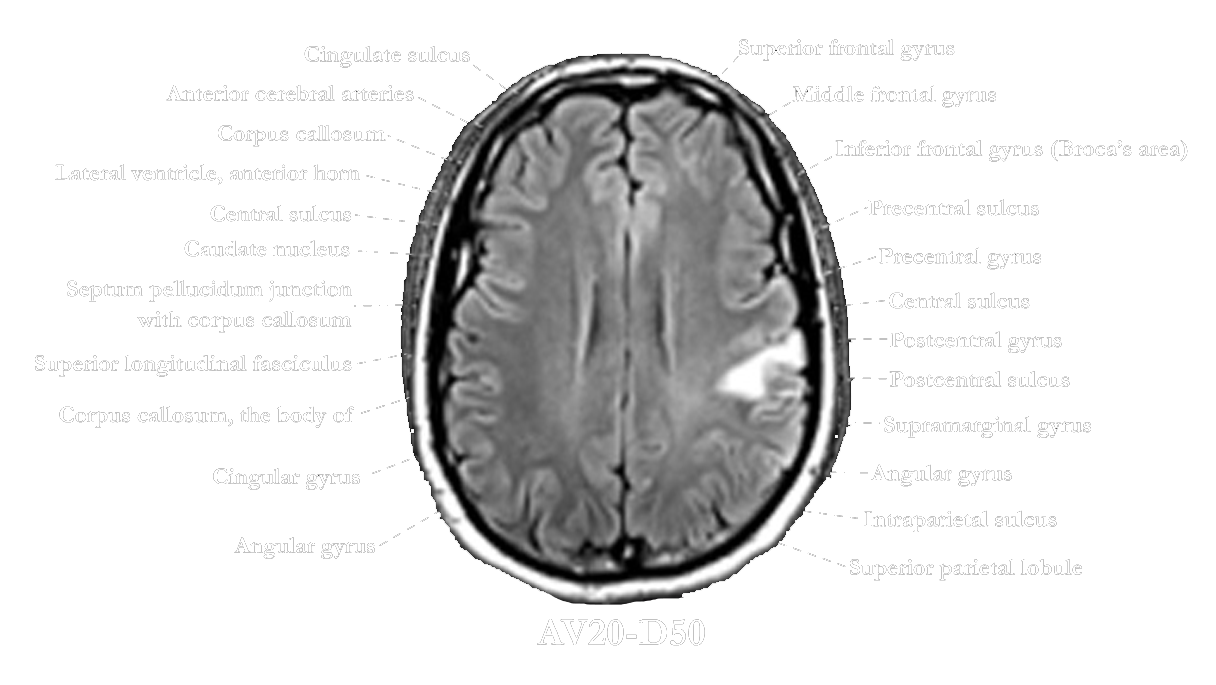 postcentral gyrus mri